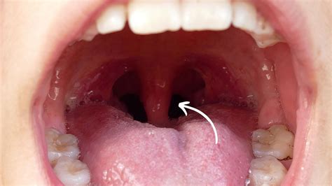 Bump uvula. Things To Know About Bump uvula. 